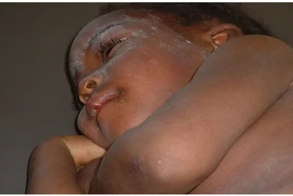 Dalili za Ugonjwa wa Surua